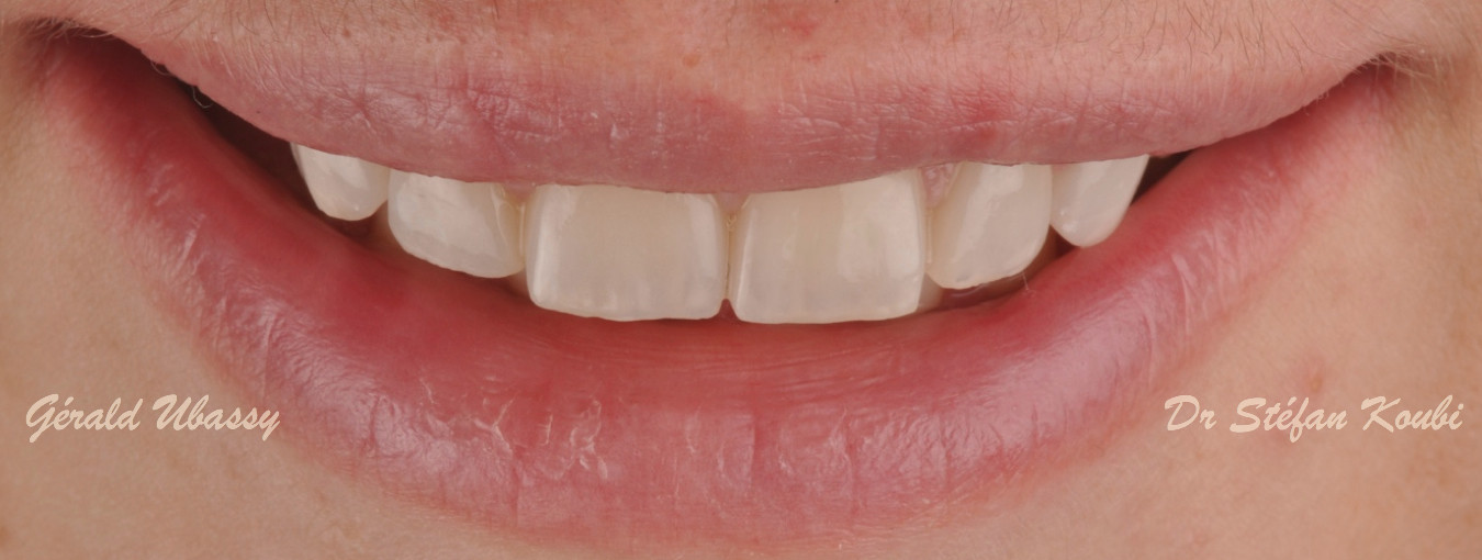 veneers and crowns /Dr Stefan Koubi